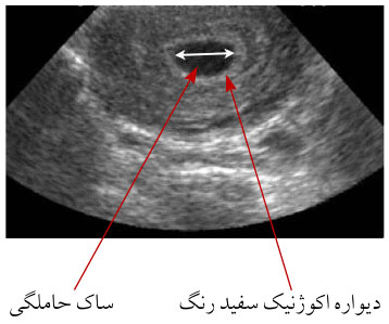 دلایل تشکیل نشدن ساک حاملگی دلایل تشکیل نشدن ساک حاملگی,ساک حاملگی,عدم وجود ساک حاملگی