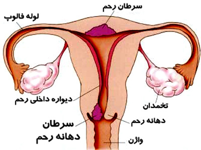 پیشگیری از سرطان رحم جلوگیری از سرطان رحم,درمان سرطان رحم