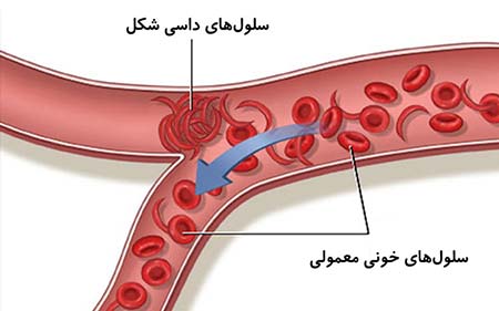 کم خونی داسی شکل کم خونی داسی شکل,بارداری با کم خونی داسی شکل,بیماری سلول داسی شکل